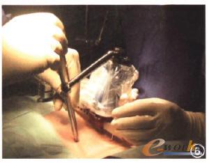 骨科手術(shù)機(jī)器人系統(tǒng)-Spinebot脊柱手術(shù)螺釘植入系統(tǒng)