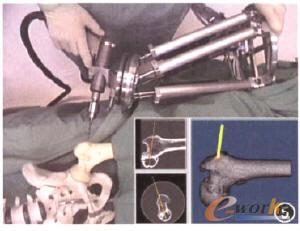 骨科手術(shù)機(jī)器人系統(tǒng)-PinTrare骨科手術(shù)專家系統(tǒng)