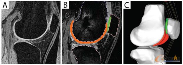 膝關(guān)節(jié)有限元模型
