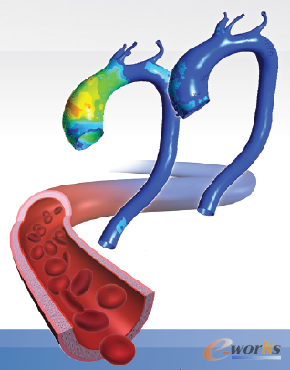 ANSYS仿真展現(xiàn)了未使用MFM(左)和使用MFM(右)的血管壁受力情況